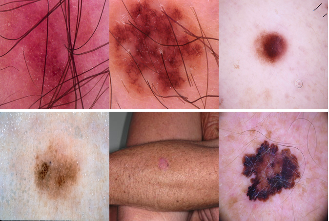 Skin Cancer detection